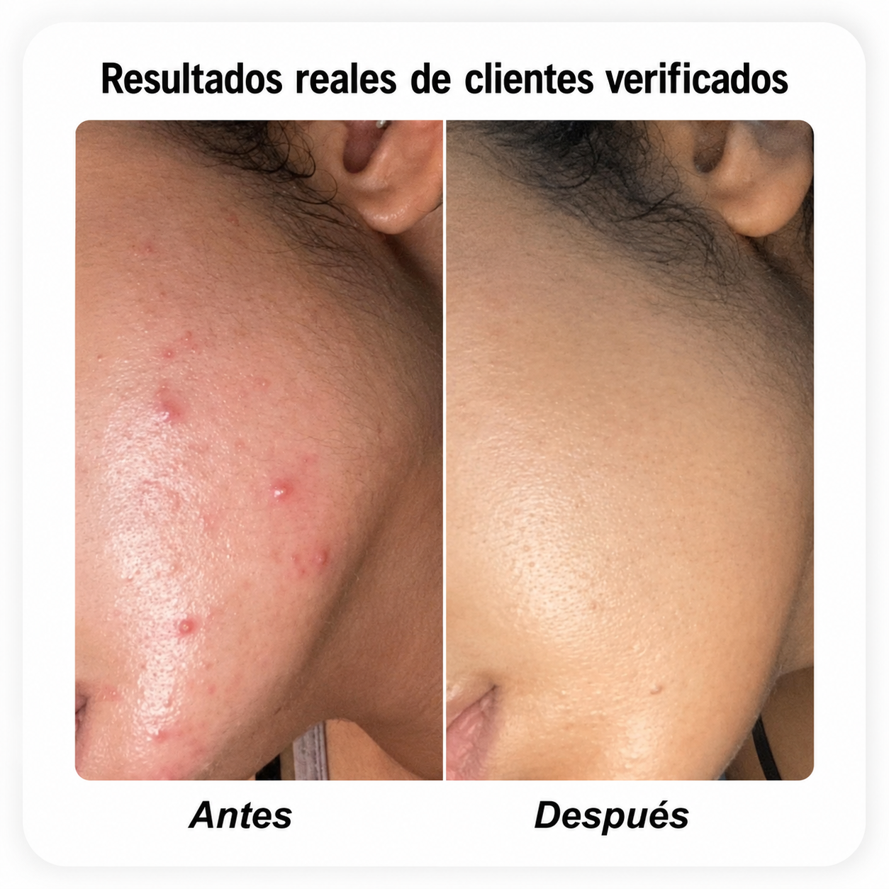 Biora™ - Serum Salicylic Acid